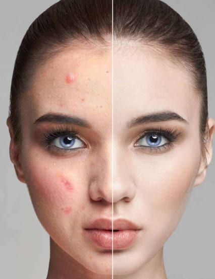 https://phoenixcosmeticcentre.com/public/acne-and-acne-marks-scars-treatment
